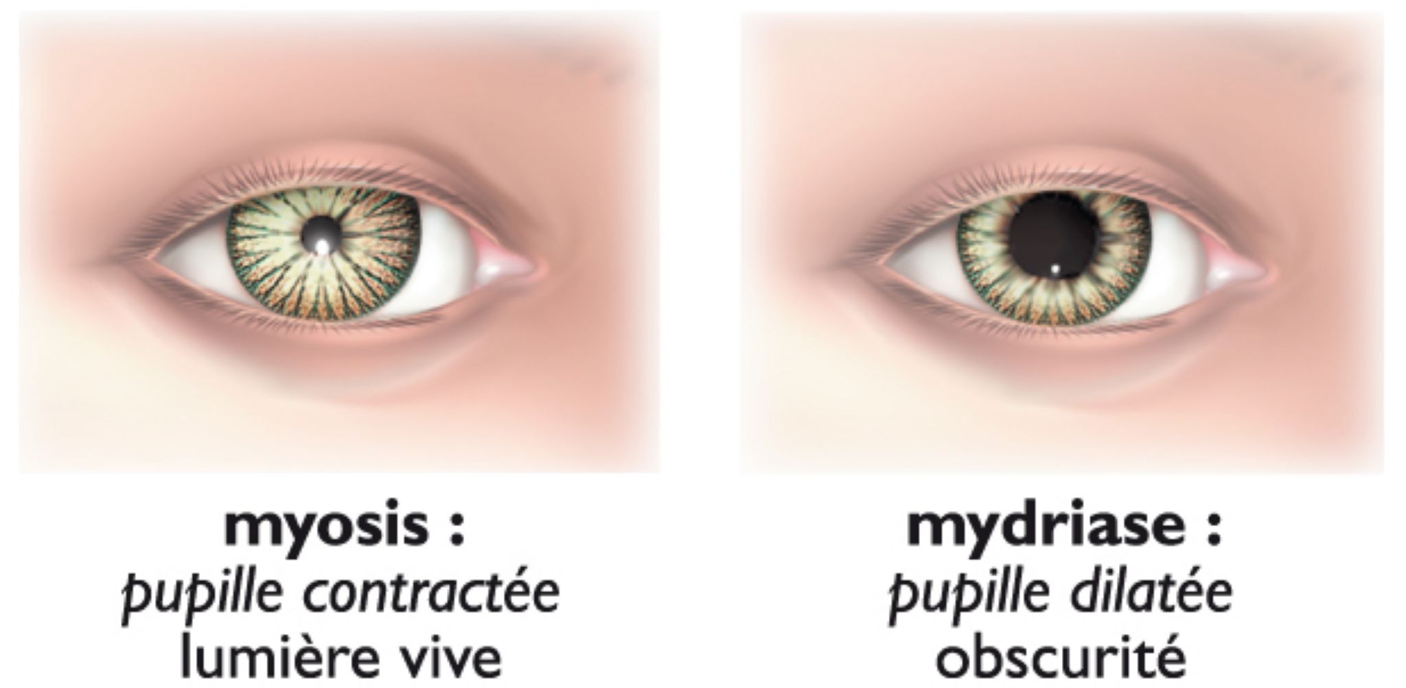 une pupille contractée et une pupille dilatée