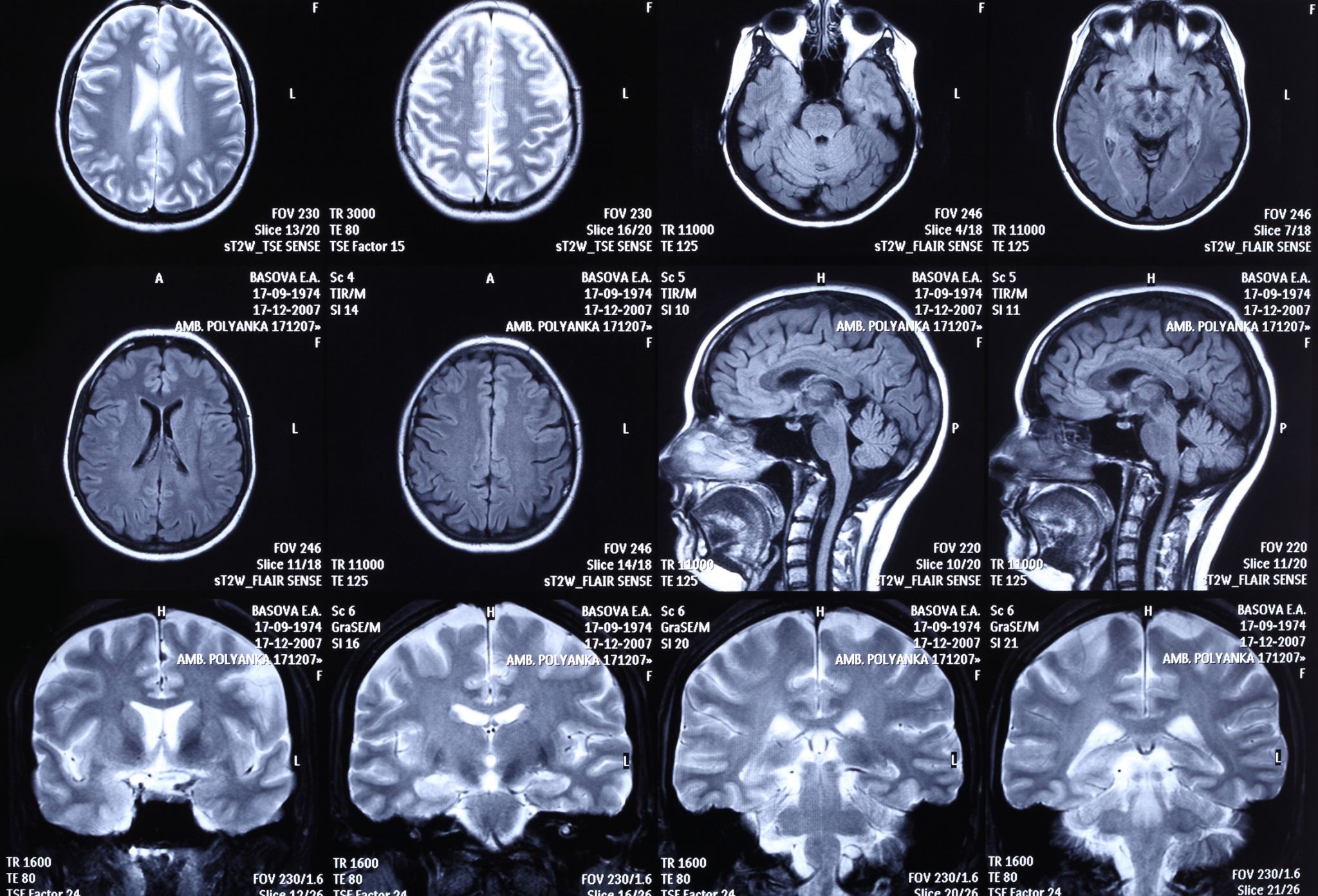 différentes coupes d’un cerveau observé aux rayons X (scanner)