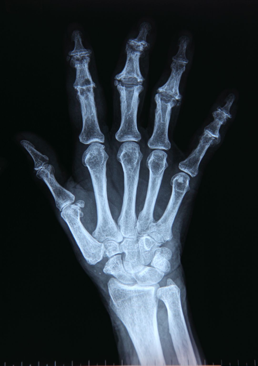 une radiographie de la main